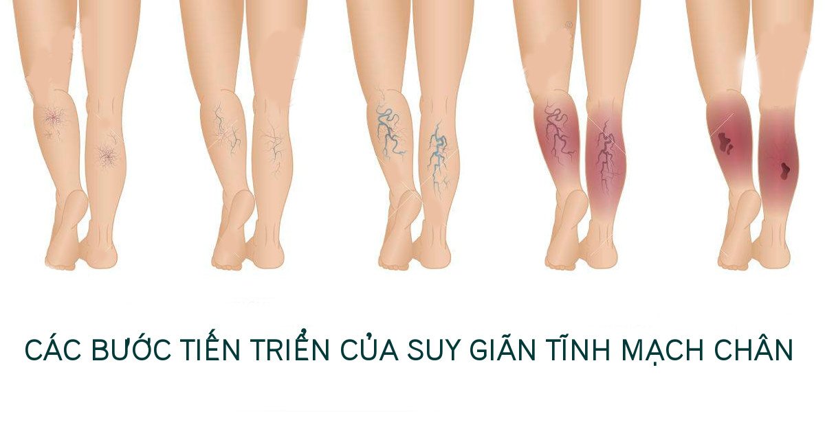 Chỉ định và các loại thuốc điều trị suy giãn tĩnh mạch chân