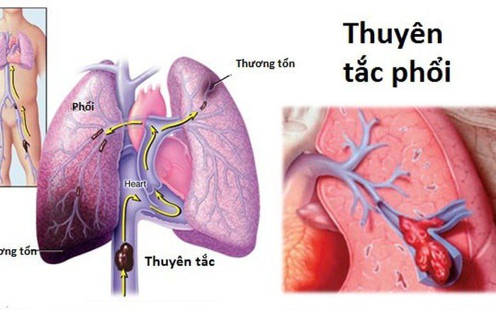 Cung lượng tim là gì?