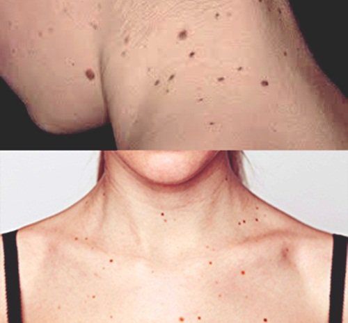 Niacinamide: Lợi ích, công dụng và tác dụng phụ