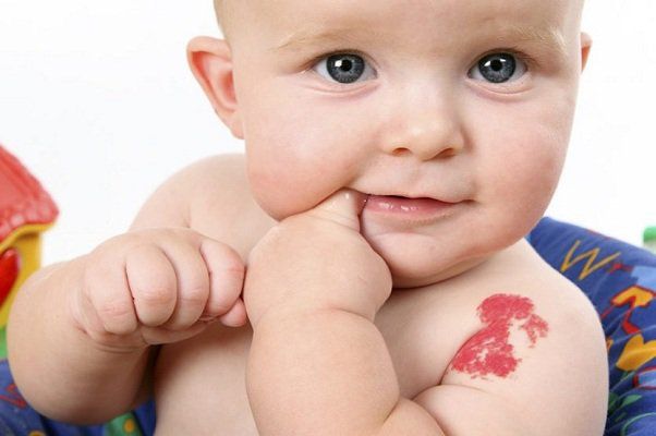 Tìm hiểu về các vết bớt ở trẻ sơ sinh thường gặp