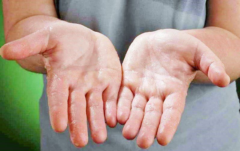Những điều cần biết về đổ mồ hôi quá mức bất thường