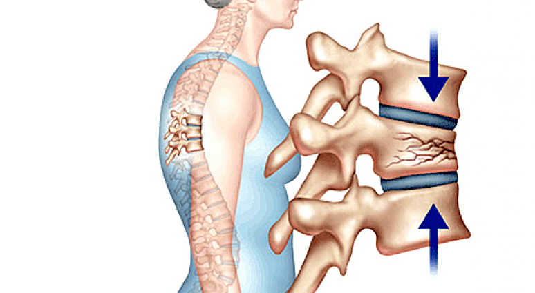 Điều trị gãy xương cột sống mà không cần phẫu thuật