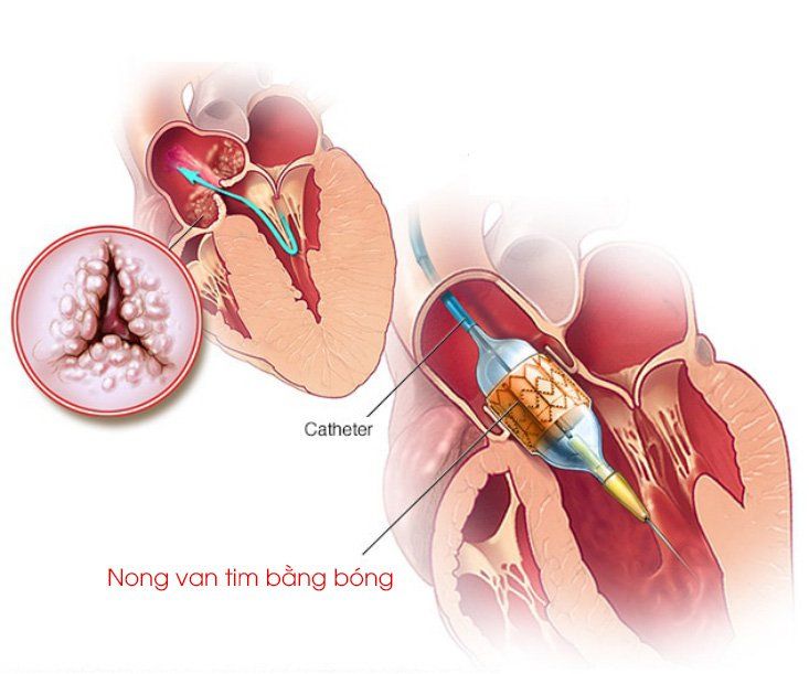 Lưu ý trong nong van tim bị hẹp bằng bóng