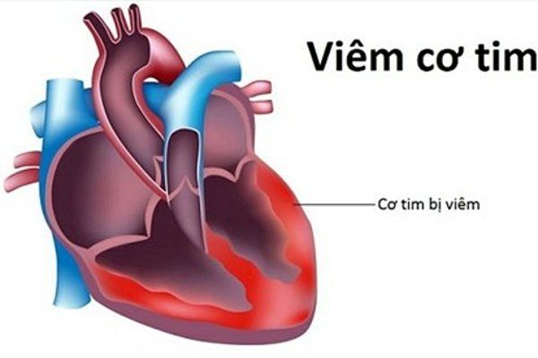 Virus gây viêm cơ tim