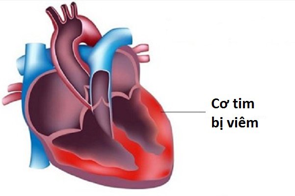 Sự khác nhau giữa vi khuẩn Gram âm và Gram dương trong việc gây bệnh là gì?
