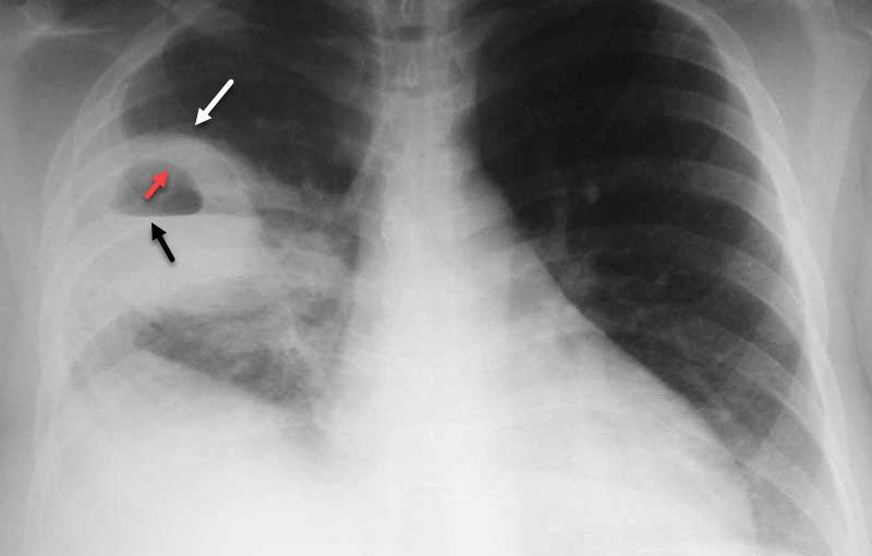 Chụp X quang phổi tư thế đỉnh phổi ưỡn giúp phát hiện tổn thương vùng đỉnh phổi