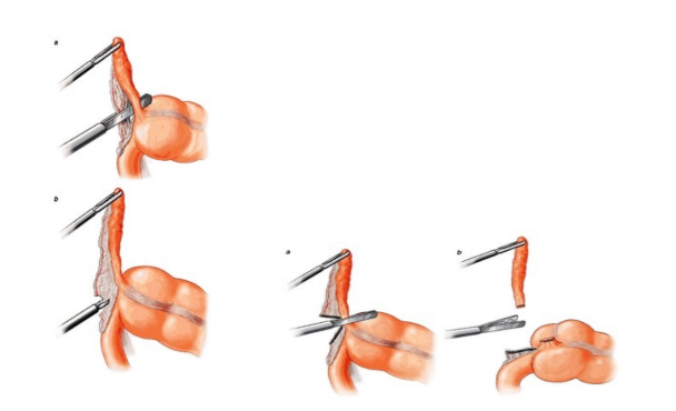 Viêm ruột thừa: Những điều cần biết