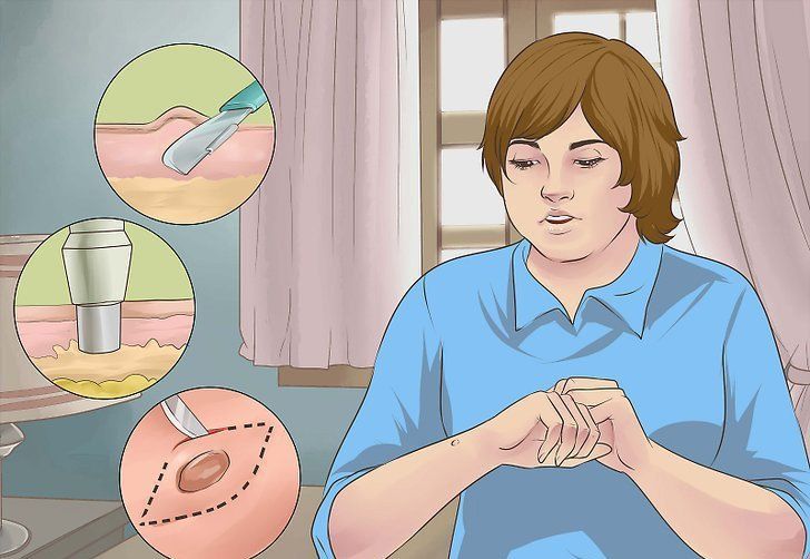 Vảy nến đồng tiền: Những điều cần biết