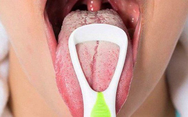 Chứng lưỡi lông đen: Những điều cần biết