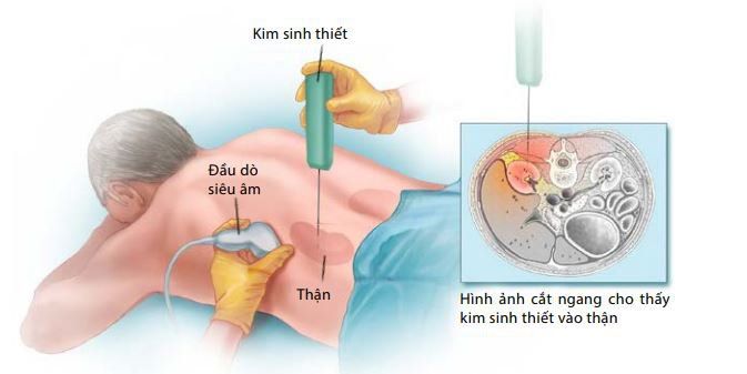 Sinh thiết thận trong hội chứng thận hư