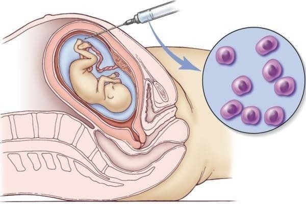Nhiễm sắc thể 18, Monosomy 18p