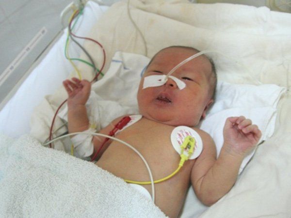 Triploidy (Thể tam bội): Dấu hiệu và triệu chứng