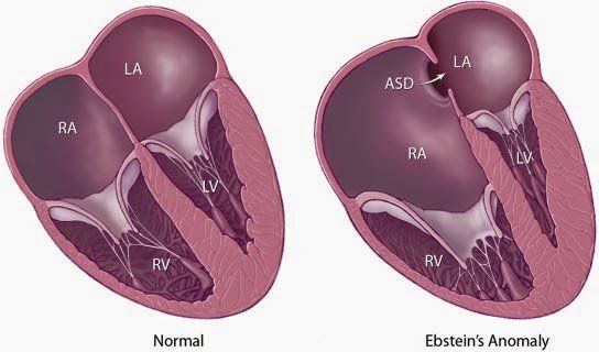 Tìm hiểu bệnh dị dạng van tim 3 lá (Ebstein)