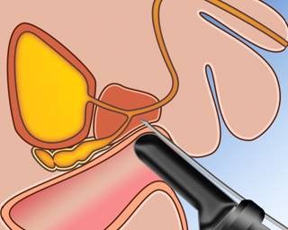 Chẩn đoán phì đại lành tính tiền liệt tuyến trên siêu âm qua trực tràng