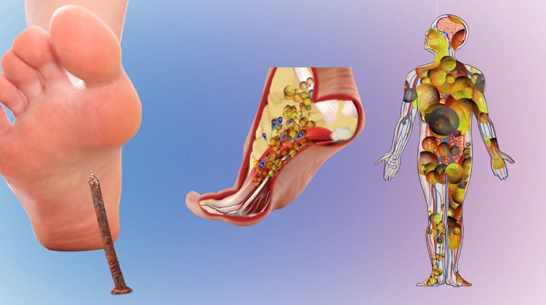 Thời gian ủ bệnh khi nhiễm vi khuẩn uốn ván