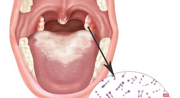 Ai tìm ra vắc-xin bạch hầu?