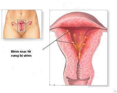 Hậu quả của nhiễm trùng hậu sản
