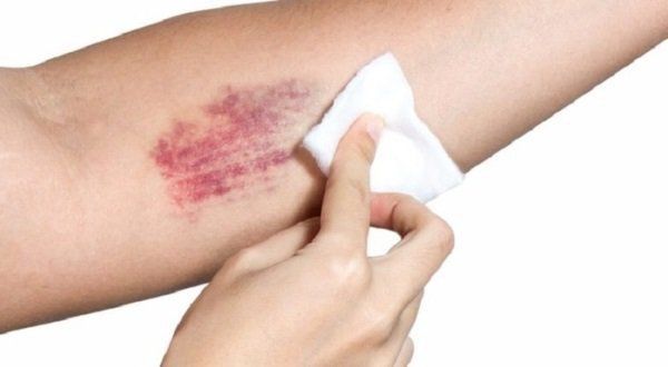 Hội chứng vùi lấp: Những điều cần biết