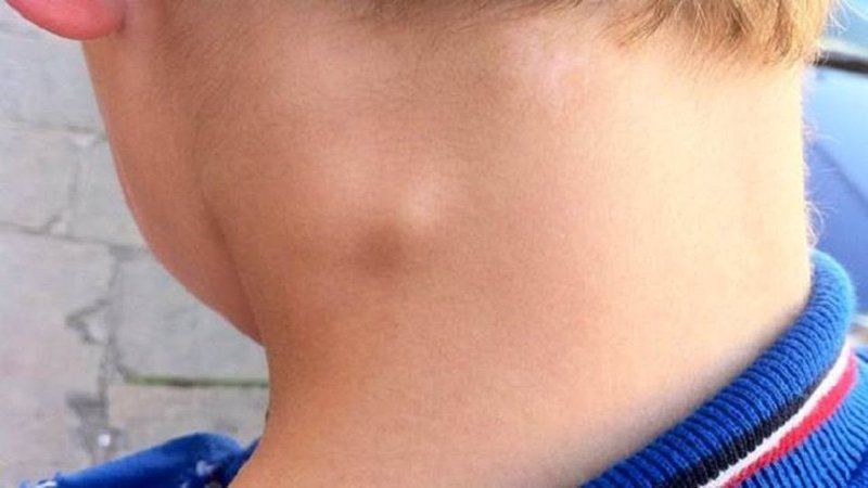 Các phản ứng có thể gặp sau tiêm vắc-xin dại