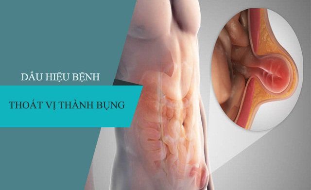 Điều trị thoát vị thành bụng sau mổ