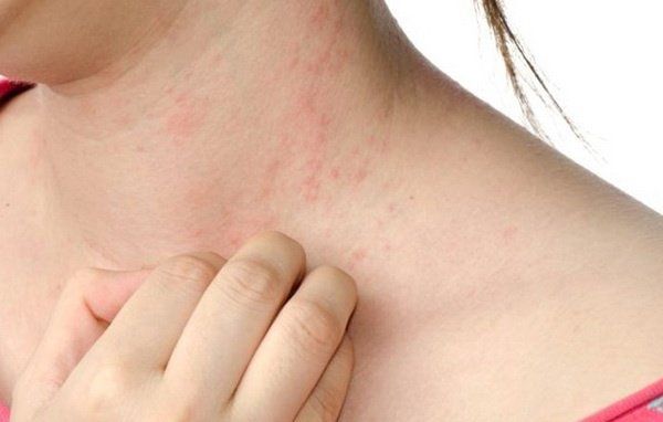 Kháng sinh có tác dụng phụ?