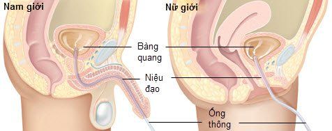 Lưu ý khi đặt thông tiểu