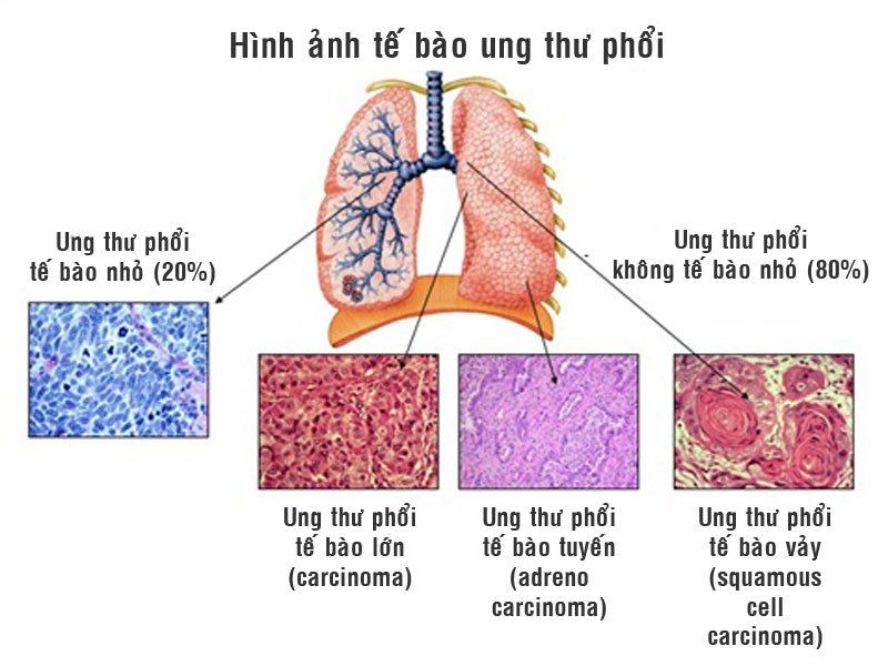 Ứng dụng PCR kỹ thuật số trong theo dõi điều trị ung thư không xâm lấn