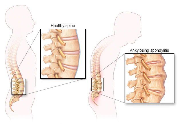 Tìm hiểu về xét nghiệm kháng nguyên HLA B27