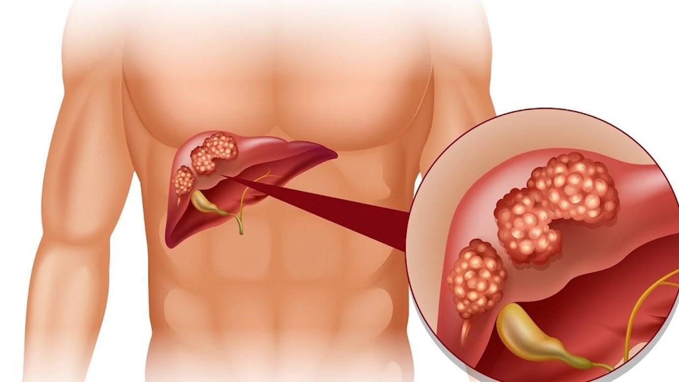 Kết quả đo độ cứng của gan sau siêu âm đàn hồi mô gan (Fibrosis)