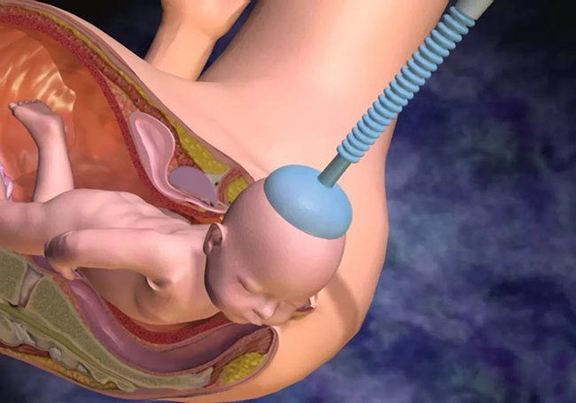 Ảnh hưởng của rách cổ tử cung và cách xử trí