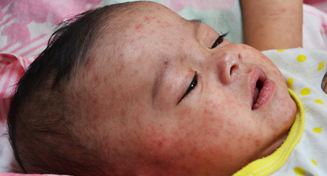 Khi nào nên tiêm vắc-xin sởi đơn thay vì vắc-xin phối hợp sởi-quai bị-rubella MMR II?