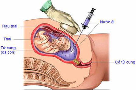Xét nghiệm QF-PCR trong chẩn đoán trước sinh