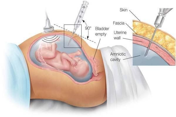 Xét nghiệm QF-PCR trong chẩn đoán trước sinh