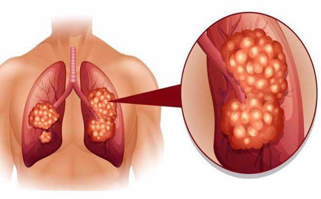 Chọc hút dịch khí phế quản qua màng nhẫn giáp