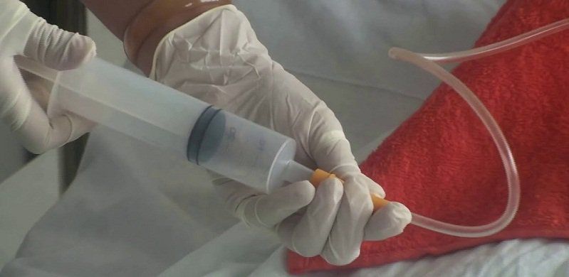 Chăm sóc bệnh nhân đặt ống thông dạ dày, tránh viêm nhiễm