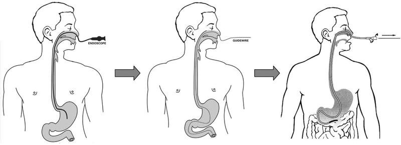 Chăm sóc bệnh nhân đặt ống thông dạ dày, tránh viêm nhiễm
