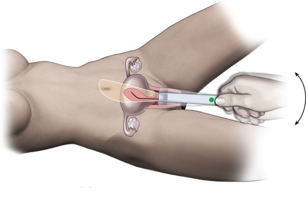 Dấu hiệu và chẩn đoán polyp buồng tử cung