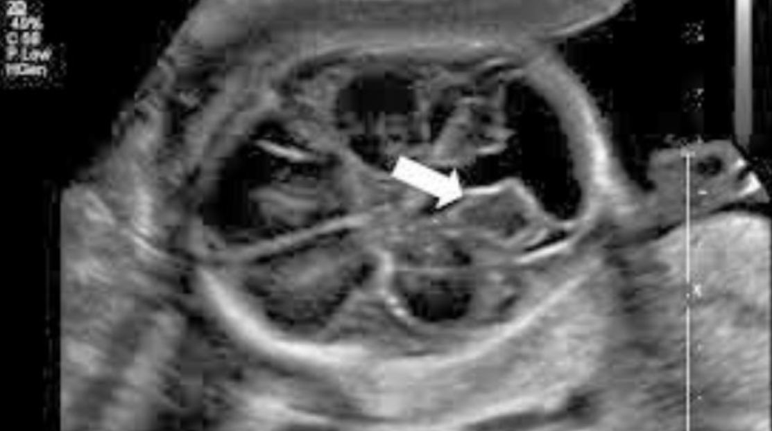 Giãn Bể Lớn Hố Sau Ở Thai Nhi