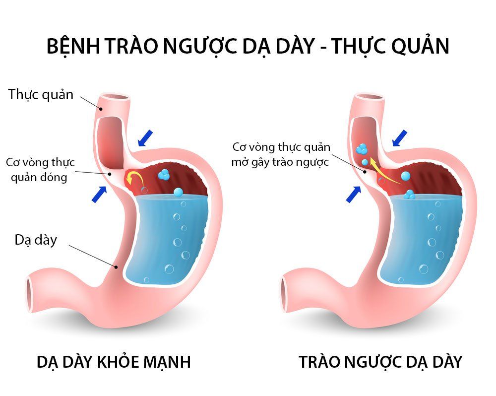 Vì sao trào ngược dạ dày thực quản lại gây ho nhiều?