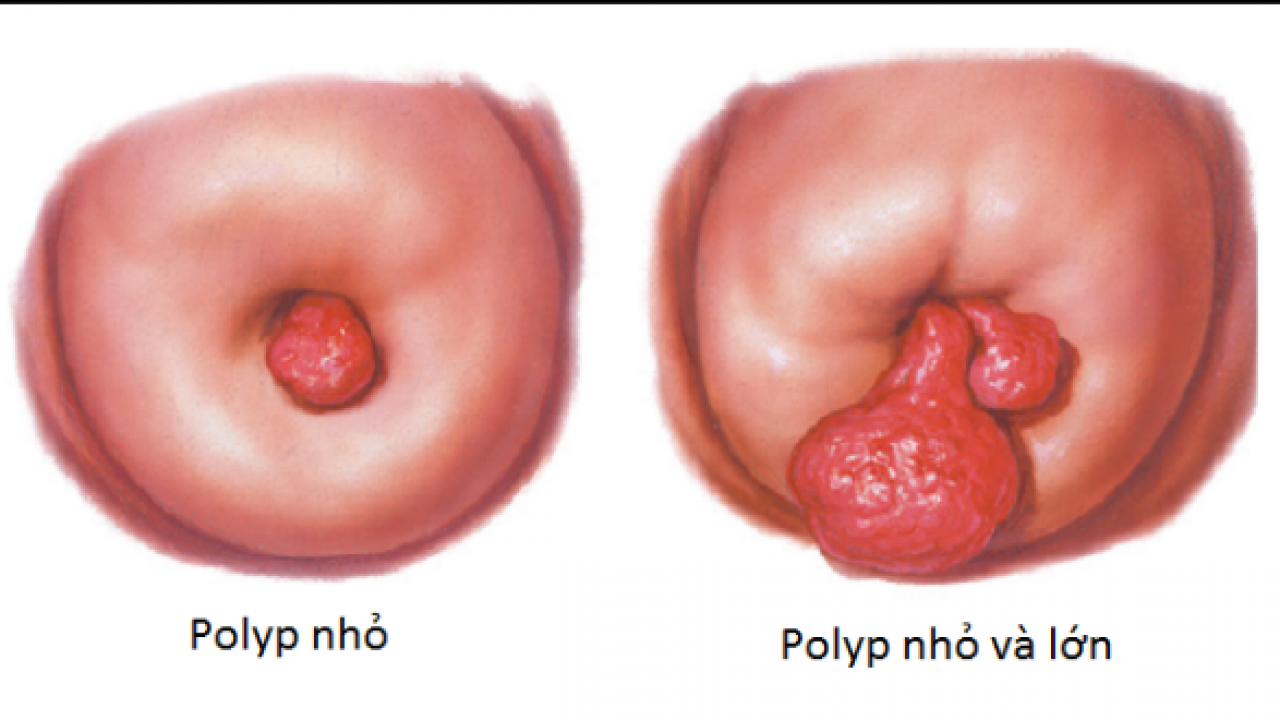 Phẫu thuật cắt polyp qua soi buồng tử cung