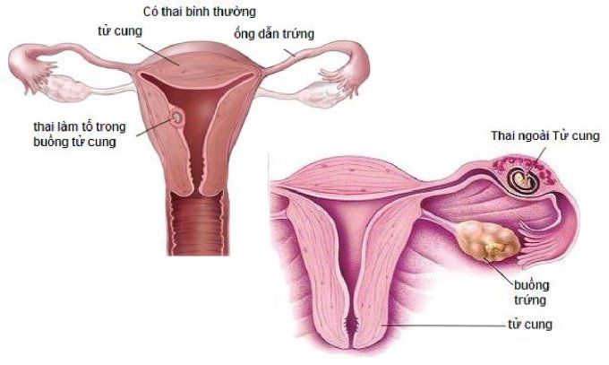 Niêm mạc tử cung dày bao nhiêu thì chuyển phôi?