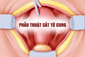 Vì sao cần cắt tử cung?