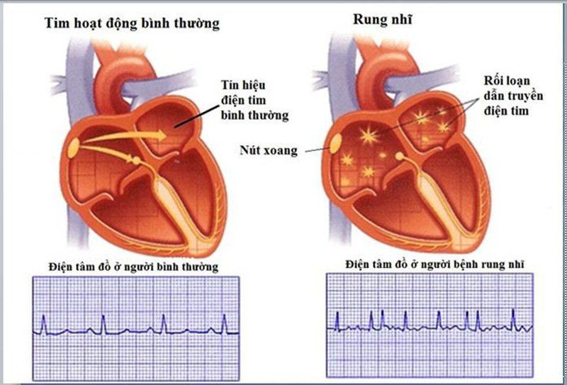 Rung nhĩ - Rối loạn nhịp tim thường gặp nhất