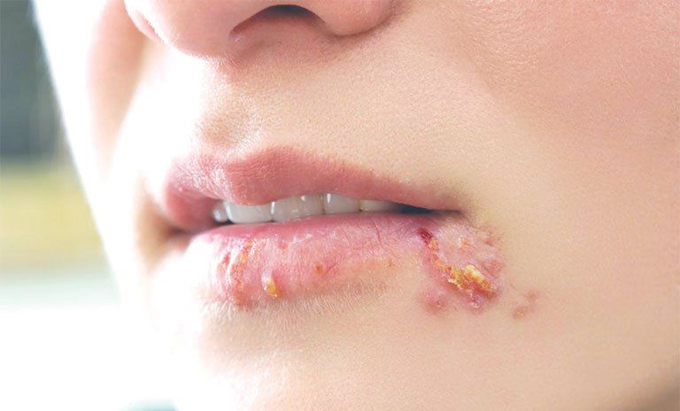 Xét nghiệm giang mai RPR: Những điều cần biết
