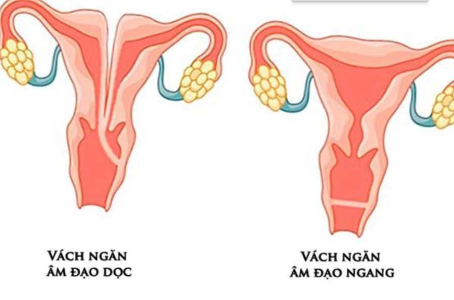 Mổ vách ngăn mở thông âm đạo