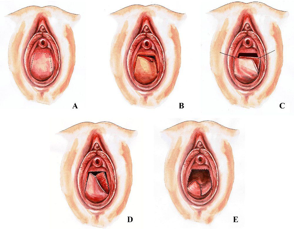 Mổ vách ngăn mở thông âm đạo