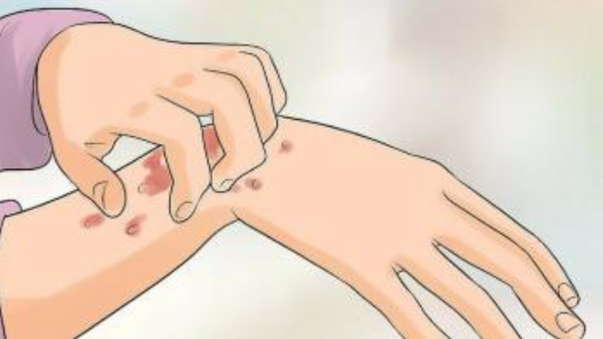 Đặc điểm bệnh giang mai theo từng giai đoạn phát triển của bệnh