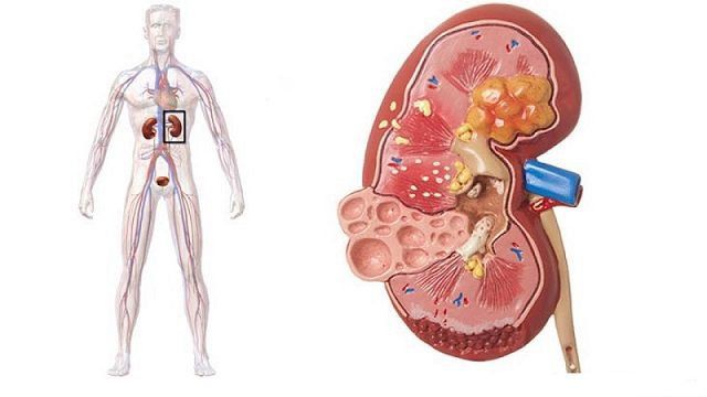 Nguyên nhân và triệu chứng viêm kẽ thận mạn