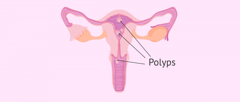 Dấu hiệu và chẩn đoán polyp buồng tử cung
