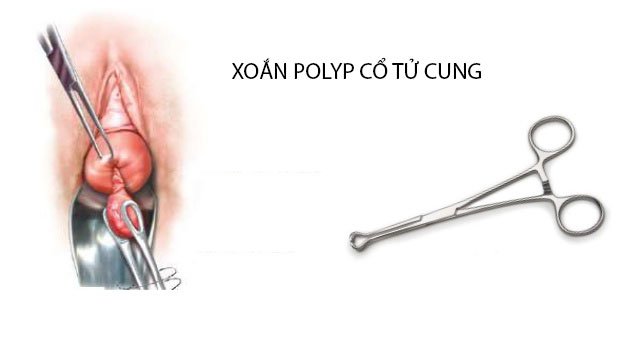 Cần phải thực hiện biện pháp chăm sóc sau xoắn polyp cổ tử cung để ngăn chảy máu?
